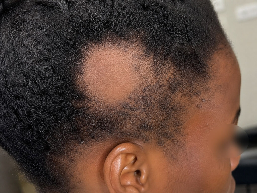 Patient presenting with alopecia areata showing a clearly defined patch of hair loss on the scalp