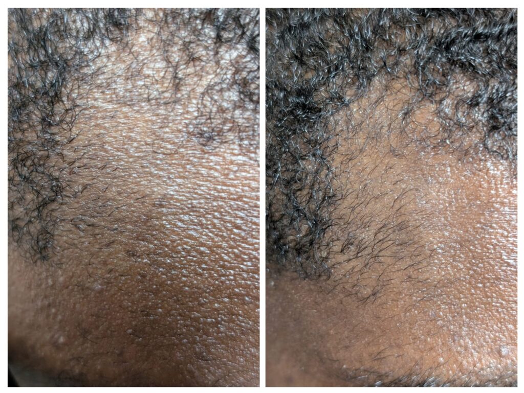 Before and after comparison showing hair regrowth at the hairline after 3 weeks of hair loss treatment: left panel shows thinning with sparse coverage, right panel shows visible new hair growth along the hairline