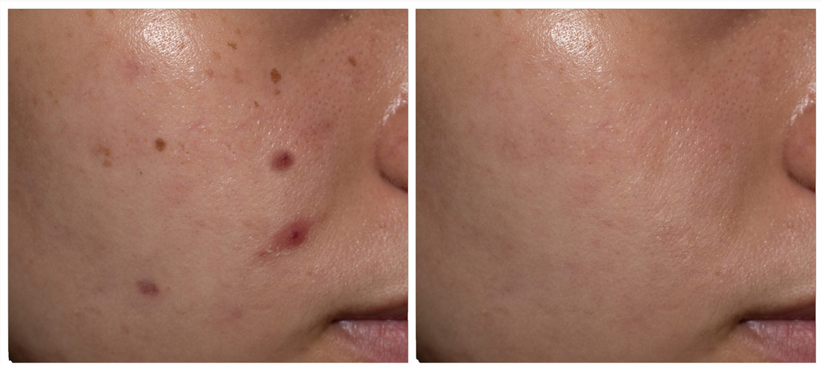Before and after comparison showing significant clearing of cystic acne following professional dermatology treatment