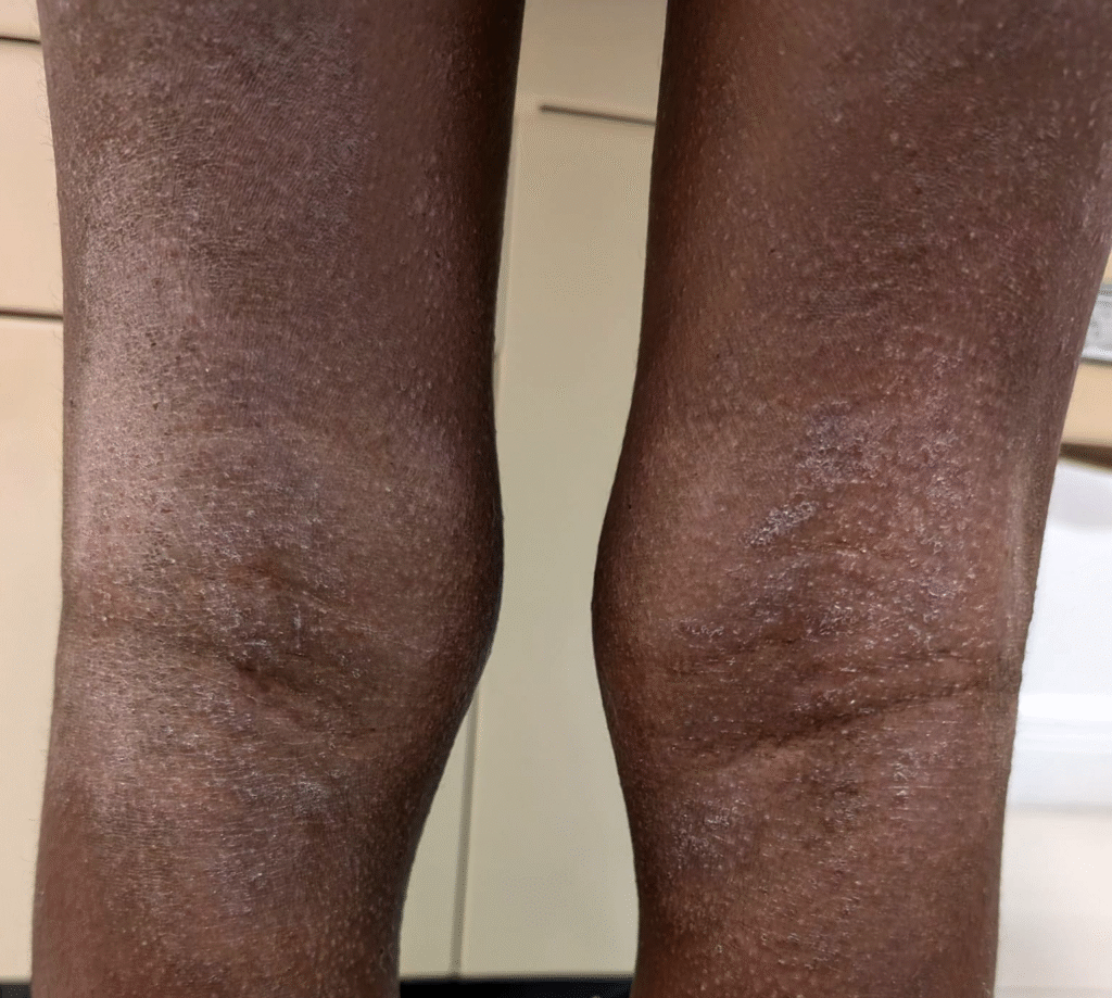 Patient presenting with eczema on both legs showing dry, scaly and inflamed skin