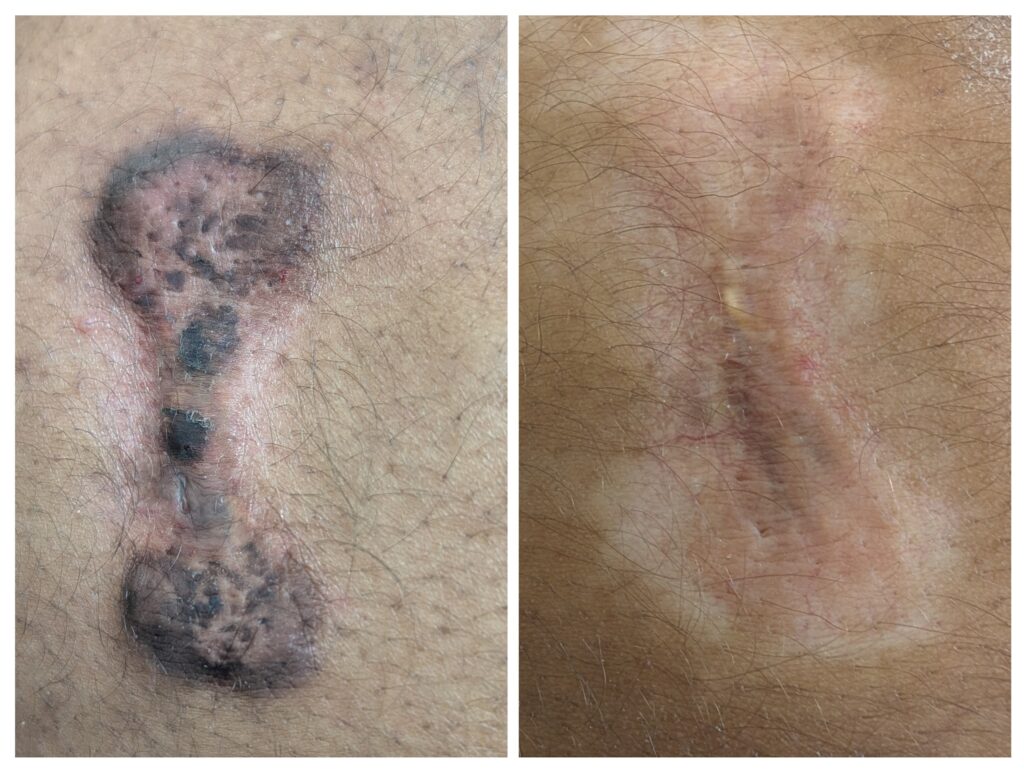 Side-by-side view showing the dramatic flattening and healing progress of a keloid scar before and after targeted treatment.