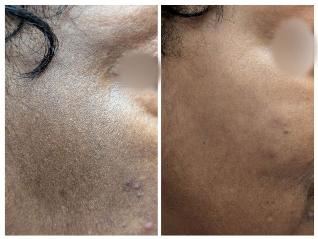 Before and after comparison showing significant reduction in melasma and skin pigmentation following professional treatment