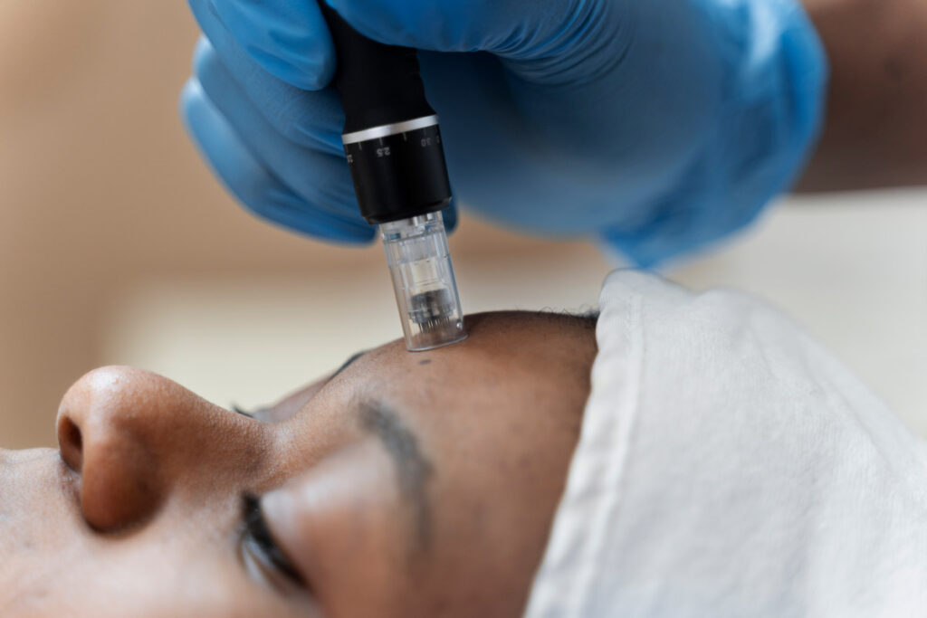 Microneedling treatment at Clare Dermatology Nassau Bahamas
