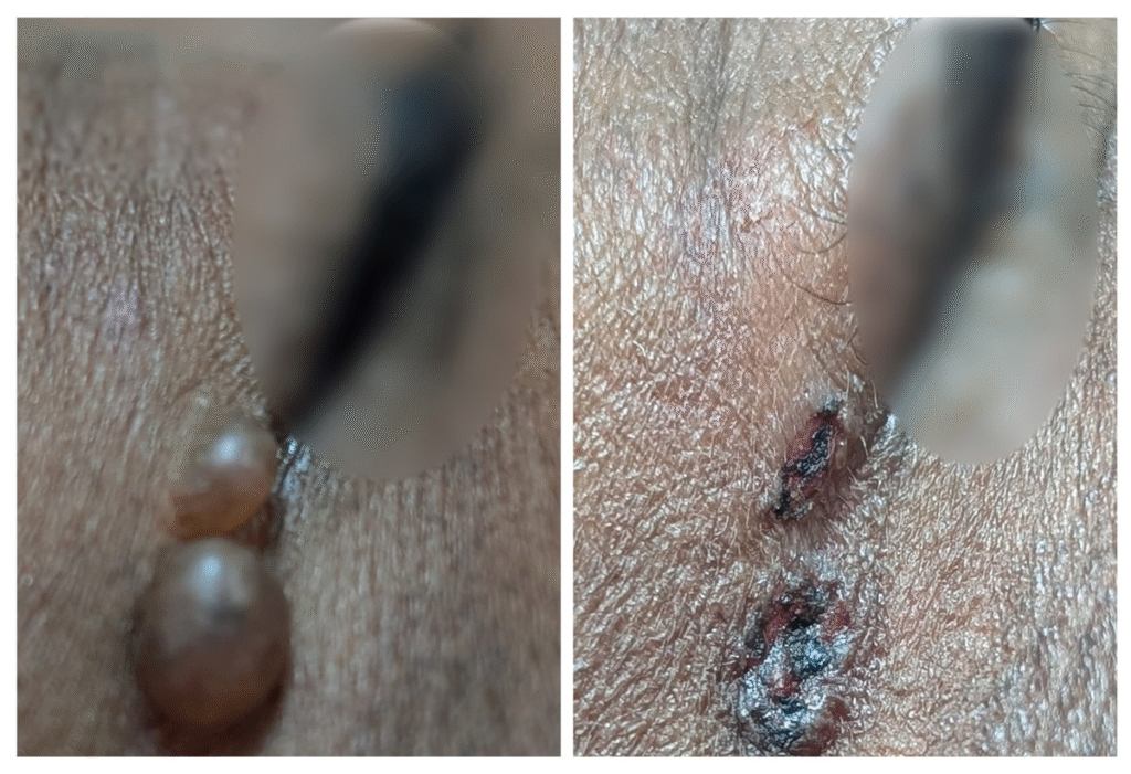 Two-panel clinical image showing removal of small cysts near the eye: left panel displays two smooth, dome-shaped cysts on dark skin in the periocular area; right panel shows the treated sites with post-procedural crusting during the healing phase
