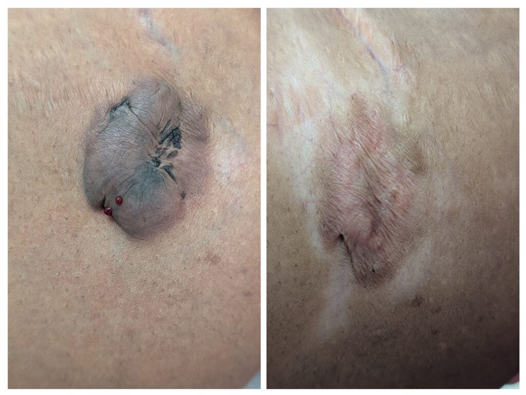 Medical example showing a large, round, dark keloid scar on the body before and after flattening corticosteroid injection treatment.