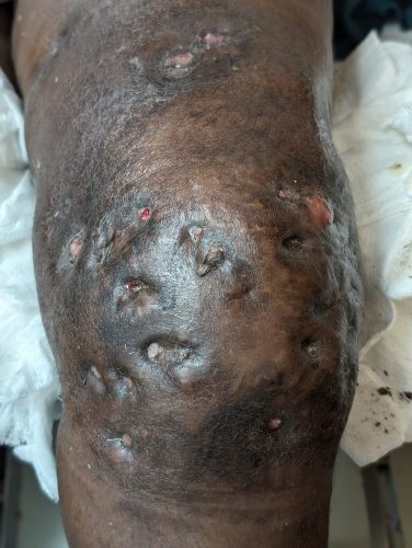 Medical clinical photograph showing severe Hidradenitis Suppurativa (HS) on a patient's knee, displaying extensive inflammation, deep nodules, and significant structural skin scarring.