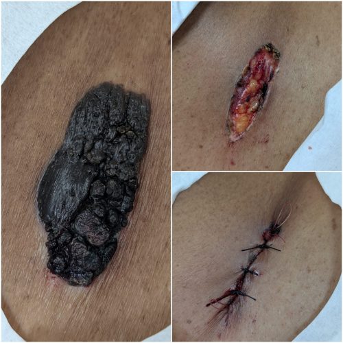 Three-panel clinical image showing surgical removal of a large, dark, nodular pigmented skin lesion: left panel displays the excised specimen on a surgical drape; top right shows the open wound immediately post-excision; bottom right shows the sutured incision closed with interrupted black sutures